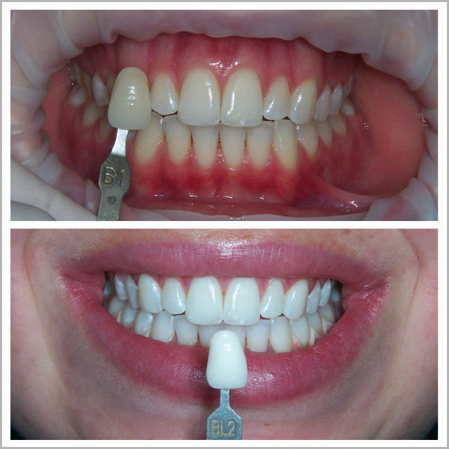Teeth whitening ultra smile